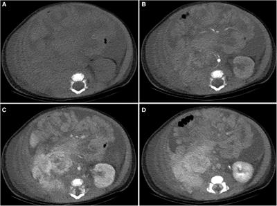 Retroperitoneal kaposiform hemangioendothelioma with kasabach-merritt phenomenon in children: A case report and review of the literature